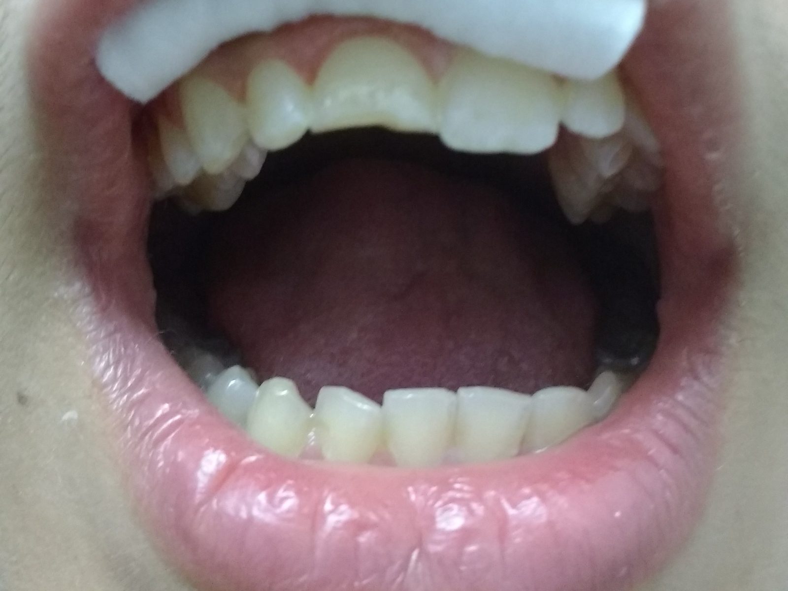 Before: fractured front tooth