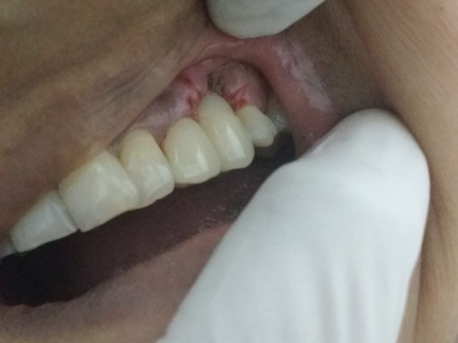 After: replaced with a dental implant