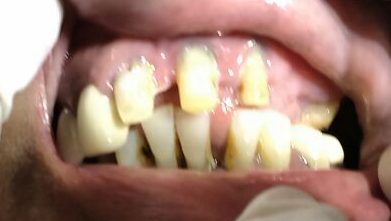Before: decayed teeth with spacing