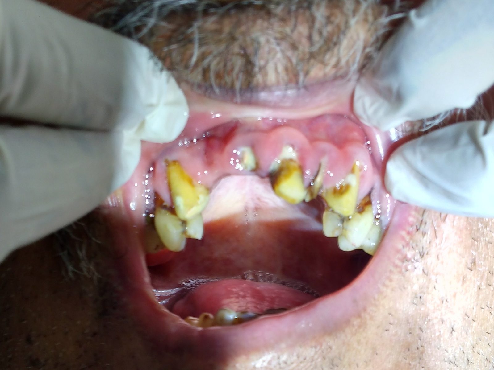 Before: missing and damaged teeth