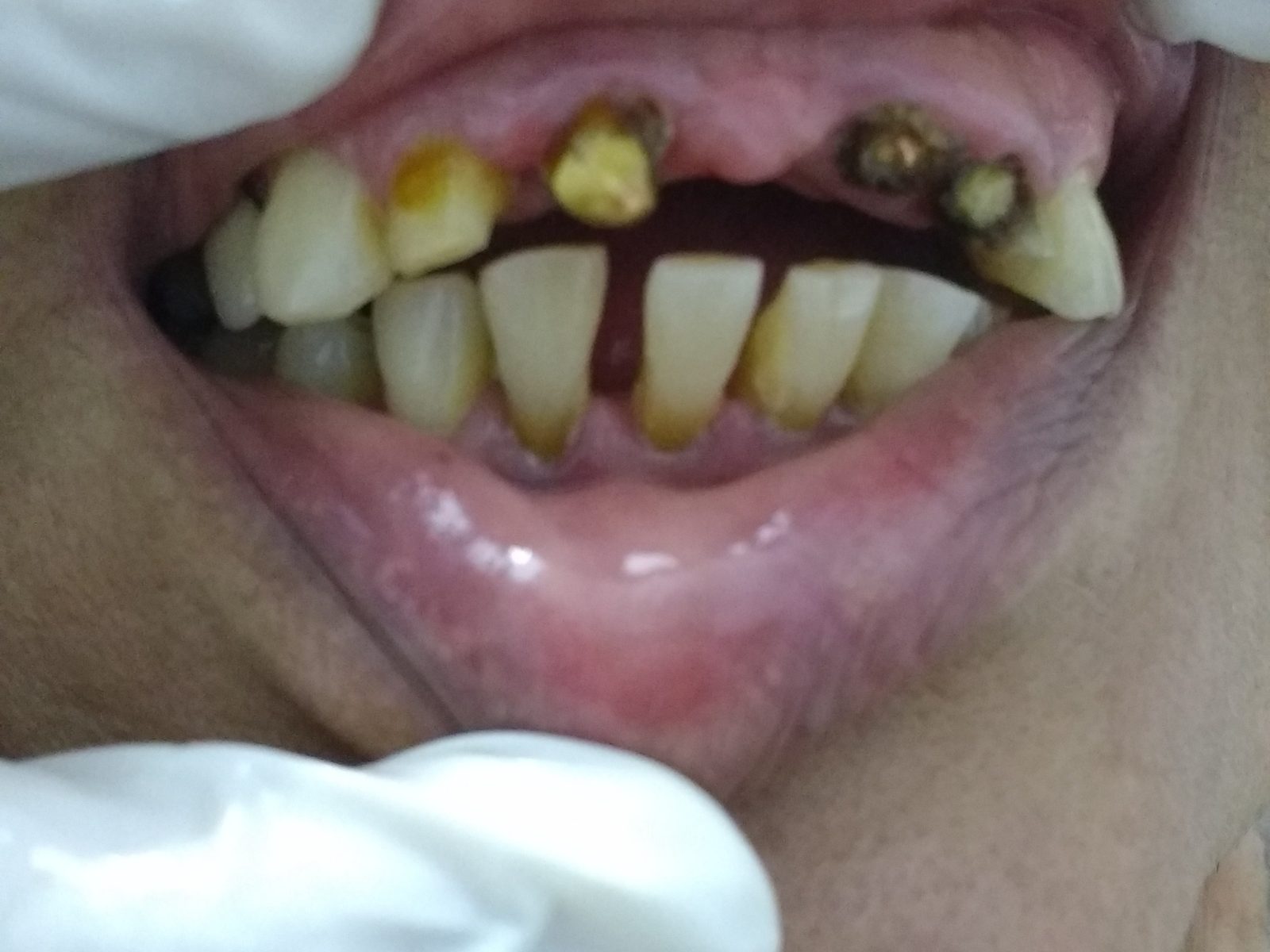 Before: missing and broken teeth