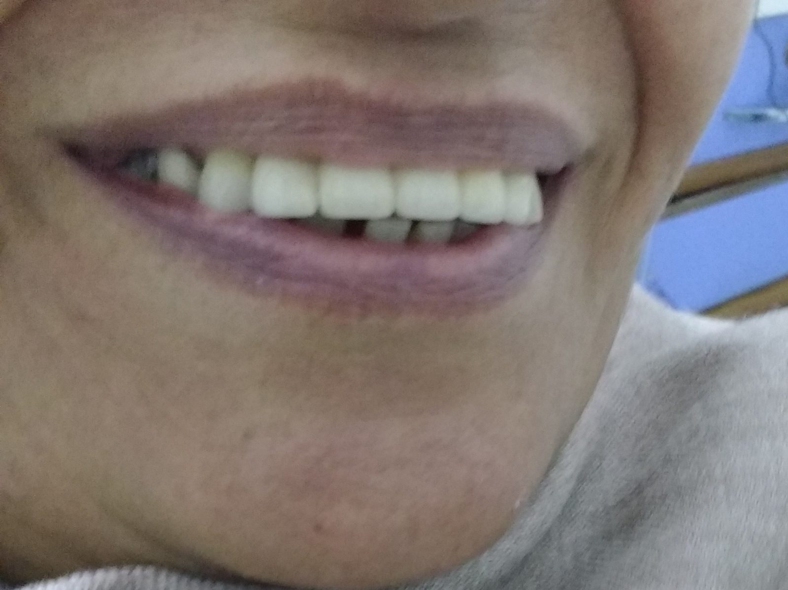 After: smile restored with bridging