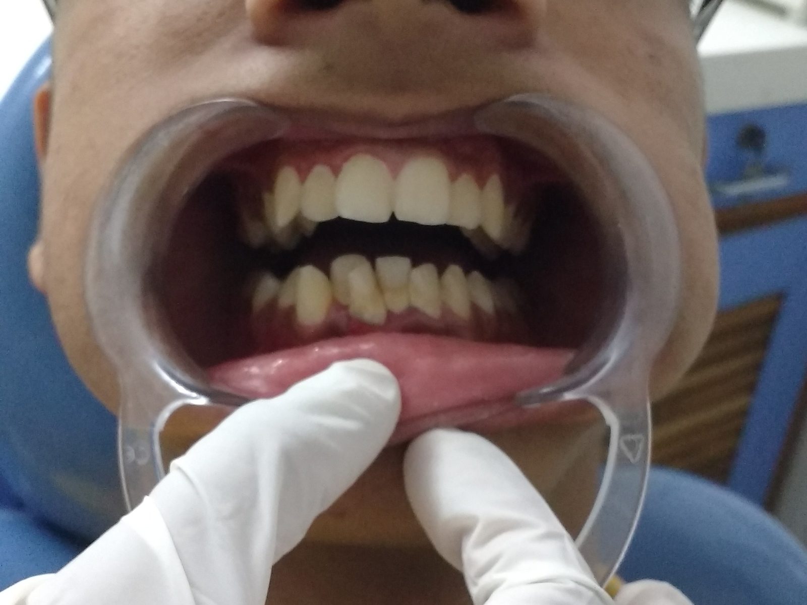 Before: malaligned lower front teeth