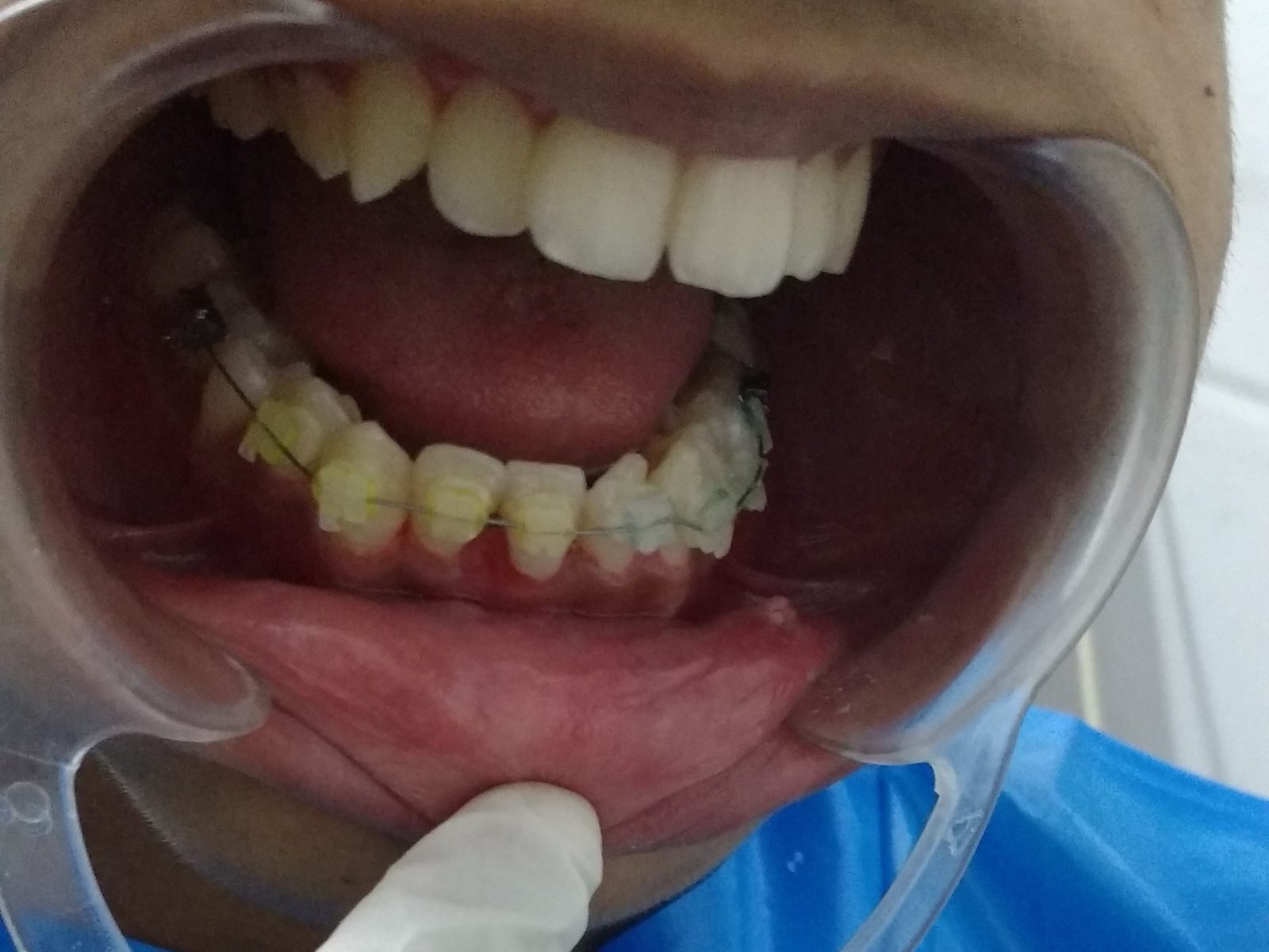 After: three months of orthodontic treatment